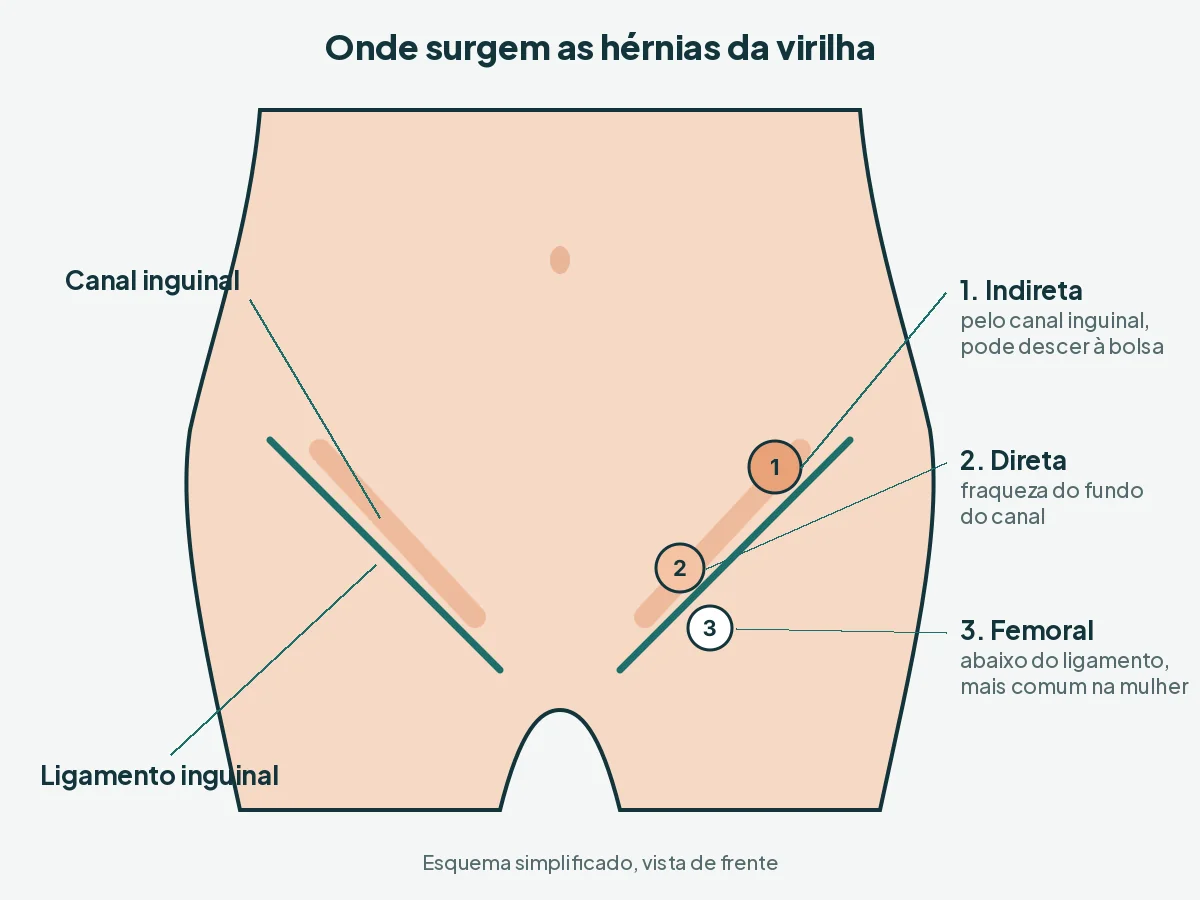 Esquema da virilha mostrando o canal inguinal e os tipos de hérnia inguinal e femoral