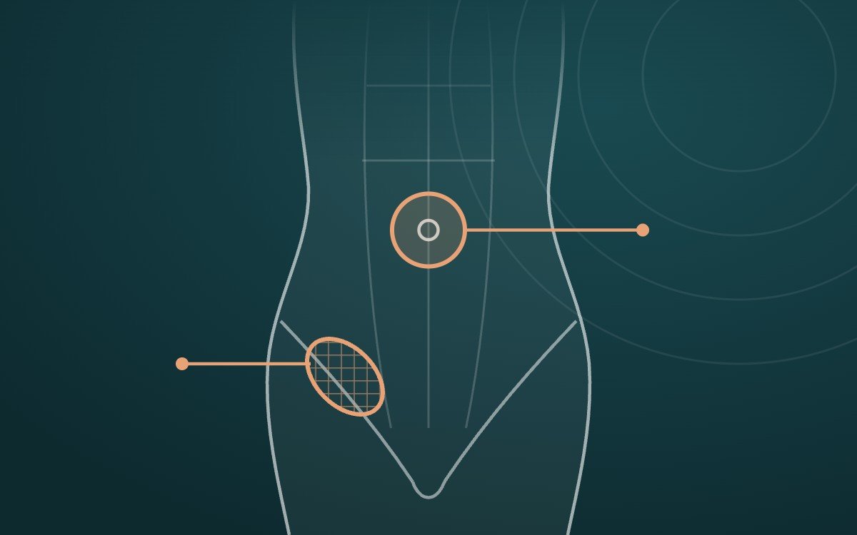 Ilustração da parede abdominal com hérnia umbilical e inguinal – cirurgia de hérnia no Rio de Janeiro