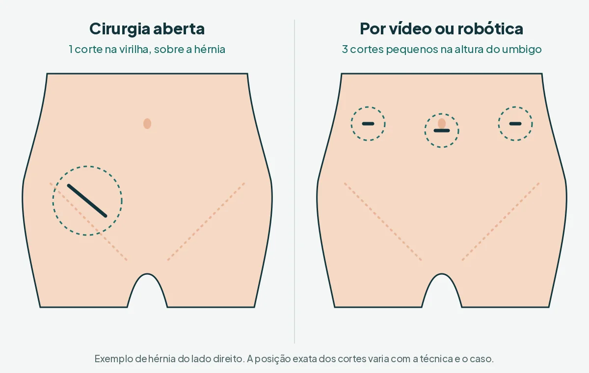Comparação dos cortes na cirurgia aberta e na cirurgia por vídeo ou robótica de hérnia inguinal