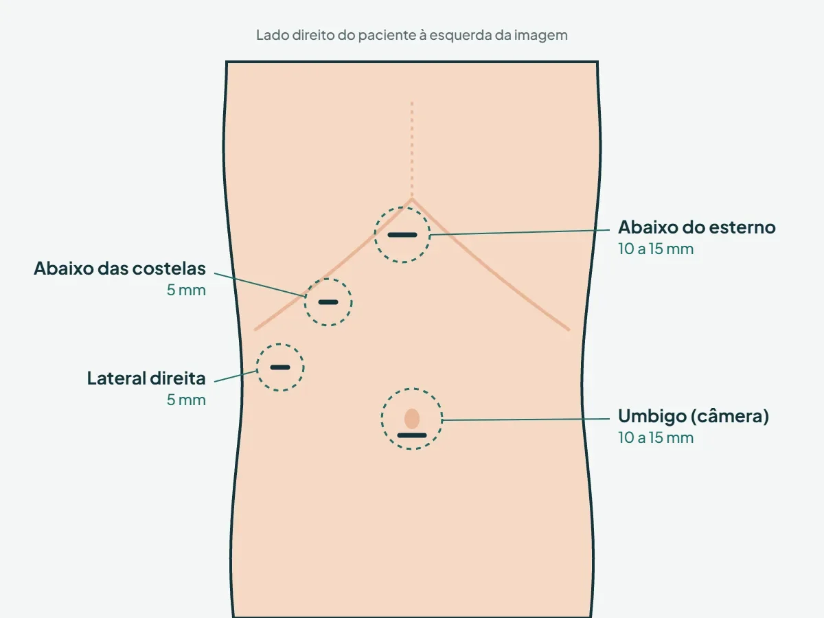 Ilustração dos quatro pequenos cortes na barriga na cirurgia de vesícula por vídeo